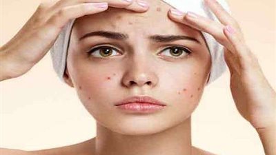 طرق سحرية للتخلص من حب الشباب.. تعرف عليها