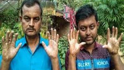 في طفرة جينية نادرة.. أسرة بدون بصمات أصابع