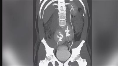 مثانة تنتج كحول ودبوس في قلب ورجل بـ 3 كلى.. أغرب حالات 2020