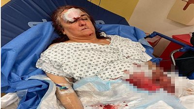 شاهد .. امرأة تتعرض لهجوم بالساطور والدماء تنزف من وجهها في نيويورك