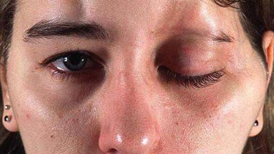 كلام صادم.. استشاري تجميل يكذب تصريحات «الدراسات الدوائية» بشأن مخاطر البوتكس