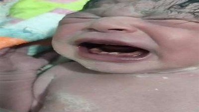 بالفيديو.. ولادة طفلة بأسنان في فكها السفلي بسوهاج