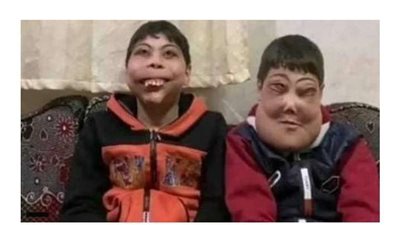 الحكومة تستجيب لعلاج أحمد ويوسف من مرض نادر