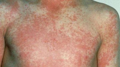 جندي جائع تسبب في وفاة 33 مليون شخص بوباء قاتل