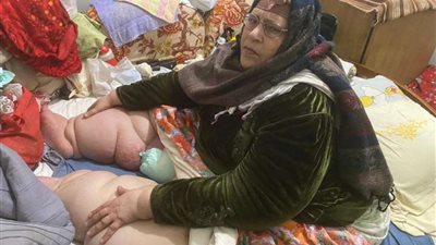 الحاجة قدرية من الدقهلية مصابة بداء الفيل طريحة الفراش: 