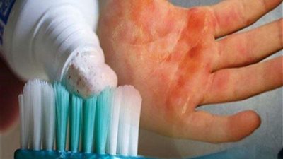 استاذ تمريض: فكرة معجون الأسنان على الحروق غير صحيحة