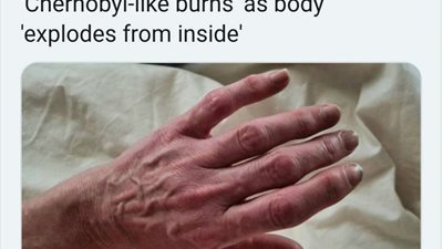 امرأة تُصاب بالتهابات غريبة 