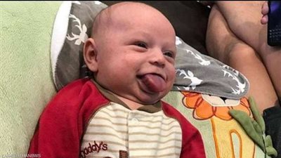 ينمو بلا توقف.. طفل يعيش طفولته بشكل مأساوي بسبب لسانه