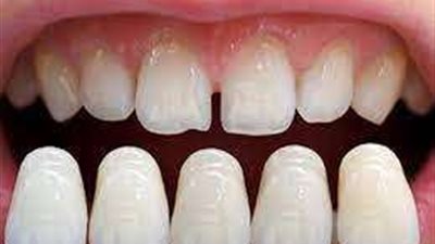 تلبيس الأسنان: لمحة عامة عن الأنواع والمزايا والعيوب