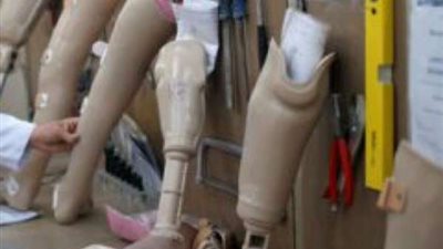 قبلة الحياة.. كيفية التسجيل في المشروع القومي لإنتاج الأطراف الصناعية