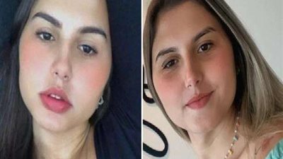 شاهد: أول توأم متطابق في العالم يخضع لعملية تغيير الجنس