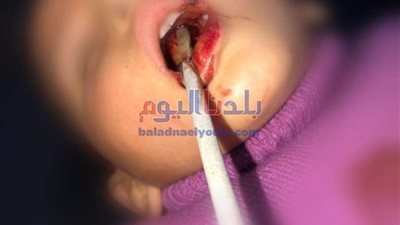 في زمن قياسي.. استخراج سيخ حديد من جمجمة طفل في مستشفى بني سويف.. صور