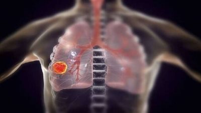 ديلى ميل: متلازمة بالقلب نادرة قد تكون أحد تأثيرات كورونا بعد أشهر من التعافى