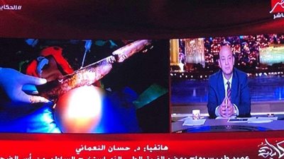 استغرقت 7 ساعات.. عميد طب سوهاج يكشف تفاصيل عملية استخراج ساطور من رأس سيدة