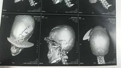 طبيب حالة الساطور يكشف تفاصيل جديدة عن الحالة (فيديو)