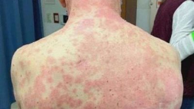 صدمة.. لقاح ضد كورونا يتسبب في مرض جلدي خطير