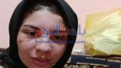 ننشر صورة إسراء عماد ضحية زوجها عقب تعافيها