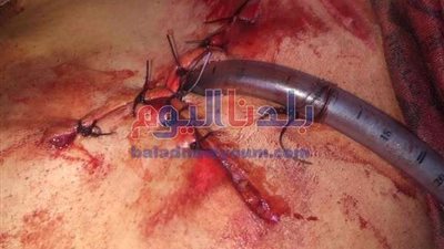 أطباء بني سويف التخصصي ينقذون حياة طفل