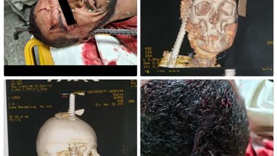 بالصور.. استخراج سيخ حديد من جمجمة شاب في أسيوط