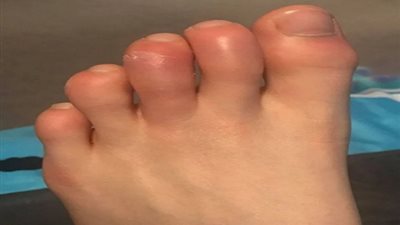 أستاذ بالقصر العيني يكشف سبب تورم القدمين..فيديو