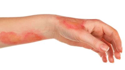 الصحة تنشر مقطعًا لكبسولة عن أنواع الحروق ودرجاتها والفرق بينها