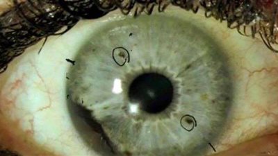 طرق الوقاية من الإصابة بالفطر الأسود