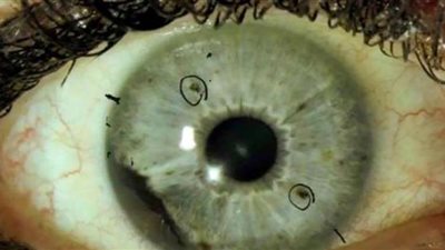 أبرزها تورم الوجه.. أعراض مرض الفطر الأسود