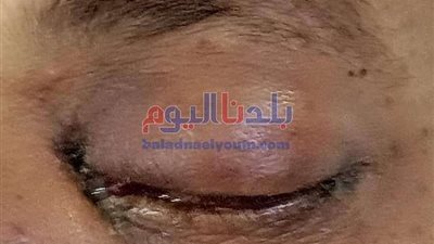 مفاجأة صادمة..  ظهور أول إصابة بالفطر الأسود بالغربية
