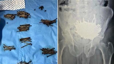 بعد 4 شهور.. استخراج مسامير من معدة مريض