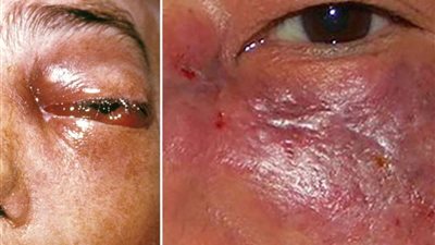 الهند تفرض قيود صارمة على تصدير دواء يعالج عدوى الفطر الأسود