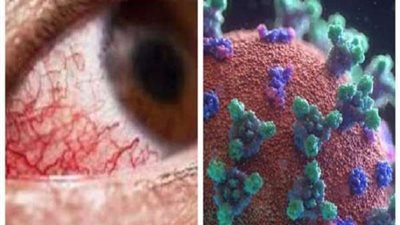 استشاري يوضح الفرق بين الفطر الأسود وحساسية العين