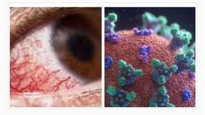 دولة عربية تعلن تسجيل 3 حالات إصابة بالفطر الأسود.. تعرف عليها