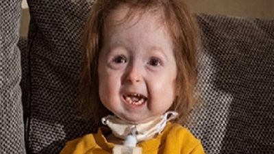 وفاة الطفلة الوحيدة المصابة بالشيخوخة المبكرة فى أوكرانيا