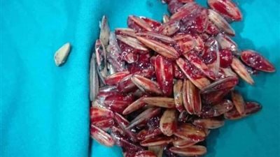 طفل ينجو من الموت بطريقة عجيبة بعد ابتلاعه لكمية كبيرة من قشر اللب السوري