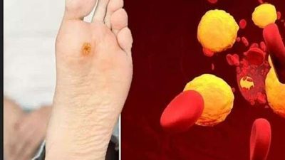 5 أعراض لارتفاع نسبة الكوليسترول في الدم على قدميك.. تعرف عليهم