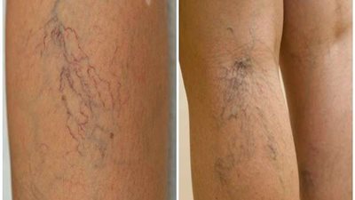 تعرف على الأشخاص المعرضون للإصابة بدوالي الساقين