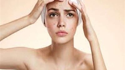 مكونات طبيعية تساعدك في التخلص من حبوب الوجه ..تعرفي عليها