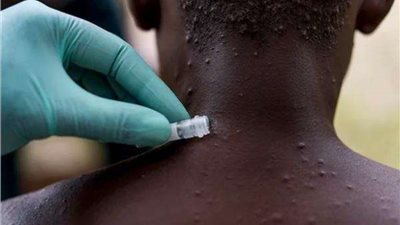 قادر على التفشي بشكل سريع.. 