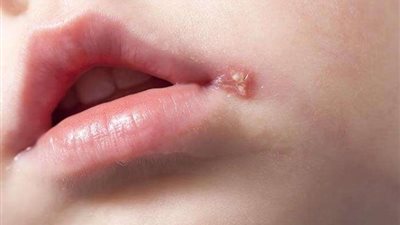 تعرف على أعراض الإصابة بـ