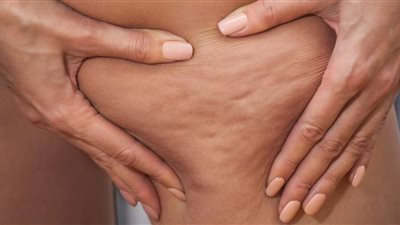 خبيرة تغذية تعلن حل للسيلوليت وتراكم الدهون بالفخذين
