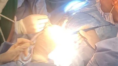 إجراء 17 عملية زراعة قوقعة للأطفال بمستشفى الهلال للتأمين الصحي بسوهاج خلال 48 ساعة