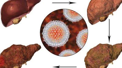 بنسبة 14%.. تراجع الحالات المتأخرة لمرضى سرطان الكبد في مصر