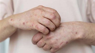 خاص| خبير فيروسات: جدري القرود لن يتحول إلى جائحة مثل كورونا