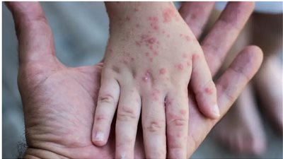 جدري القرود يُهدد الأمن الصحي لجمهورية الكونغو الديمقراطية..  كيفية الوقاية منه