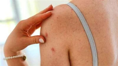 بعد انتشاره في عدة دول حول العالم.. الأعراض الشائعة لفيروس جدري القرود وعلاجه وطرق الوقاية