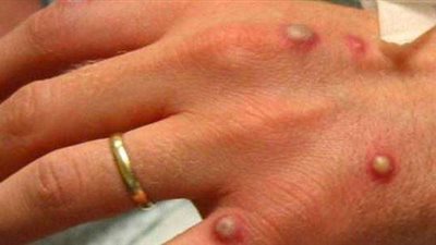 شريف حتة: جدري القرود يتشابه مع الجدري في الأعراض ويحتاج إلى وعي صحي لمكافحته