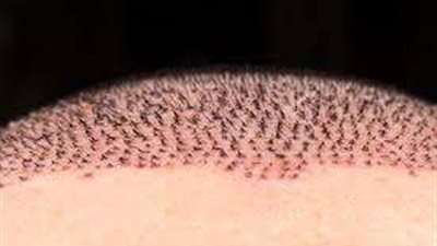 إجراءات سلامة يجب اتّباعها طوال فترة عملية زراعة الشعر