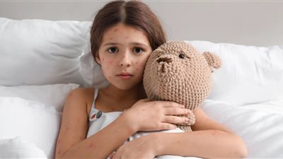 كيف تتعامل مع جدري الماء في المنزل؟ نصائح هامة للتعافي السريع