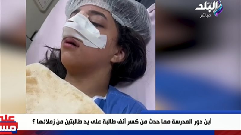 طالبة تم كسر أنفها