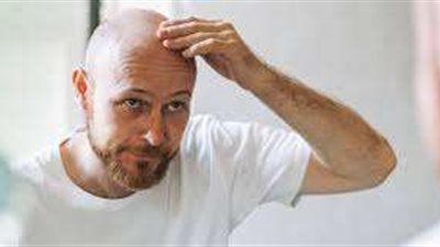 بالسكر الطبيعي.. علماء يكتشفون طريقة فعالة لعلاج الصلع